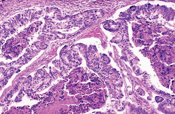 Image: Histopathology of advanced bowel adenocarcinoma in which the glands are much larger and filled with necrotic debris (Photo courtesy of University of Utah School of Medicine).