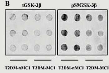 Image: Dot blots showing the expressions of total glycogen synthase kinase-3β (tGSK-3β) and p-GSK-3β (ser9) in the platelets; the differences of platelet GSK-3β activity between T2DM-nMCI group and T2DM-MCI group (Photo courtesy of Tongji Medical College).