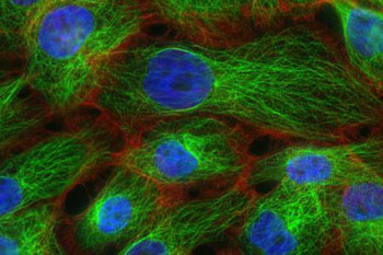 Image: Photomicrograph of metastatic breast cancer cells (Photo courtesy of the [US] National Cancer Institute).