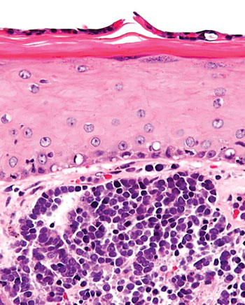 Image: Histopathology of Merkel cell carcinoma, an aggressive neuroendocrine tumor of the skin caused by Merkel cell polyomavirus (Photo courtesy of Nephron).