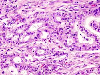 Image: Micrograph of pancreatic ductal adenocarcinoma—the most common type of pancreatic cancer (Photo courtesy of Wikimedia Commons).