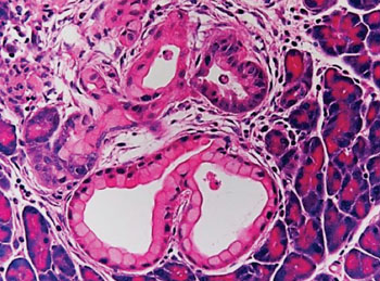 Image: Histopathology of two clusters of precancerous cells (lower half of image), which arose in pancreatic cells expressing the pancreas/duodenum homeobox protein 1 and the cancer gene KRAS (Photo courtesy of Sharon Friedlander).