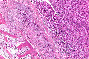 Image: Intermediate-magnification micrograph of an osteosarcoma (center and right of image) adjacent to nonmalignant bone (left-bottom of image) (Photo courtesy of Wikimedia Commons).