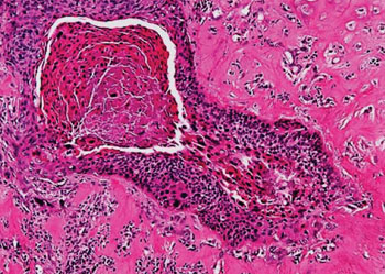 Image: Histopathological findings in laryngeal squamous cell carcinoma (Photo courtesy of Nikon Microscopy).