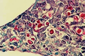 Image: Histopathology of Cryptococcus neoformans in the lung of a patient with AIDS; the inner capsule of the organism stains red (Photo courtesy of Andrew Schott).