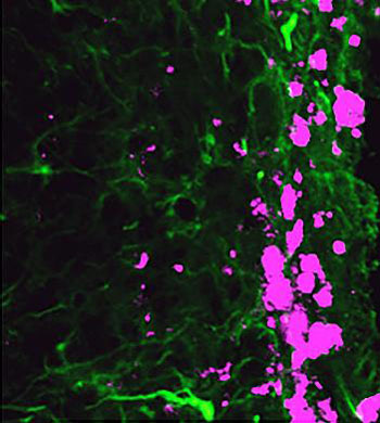 Image: Reprogrammed stem cells (green) chase down and kill glioblastoma cells (pink), potentially offering a new and more effective treatment option for a disease that has not had any in more than 30 years (Photo courtesy of the University of North Carolina).
