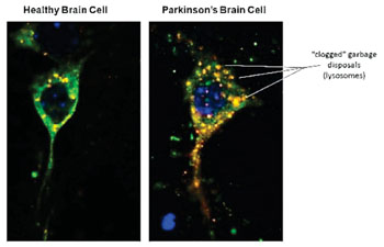 Image: Left: A healthy neuron with the alpha-synuclein (green) protein diffusely spread in the cell. The bright reddish dots are the garbage disposal lysosomes with alpha-synuclein entering, which gives them an orange hue. Right: This is a defective neuron from a Parkinson’s brain. The lysosomes are enlarged and puffy because the alpha-synuclein is stuck outside and unable to enter the lysosomes (Photo courtesy of the US National Institute of Health).