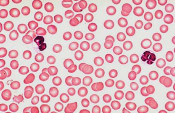 Image: Photomicrograph of blood smear devoid of platelets from a patient with thrombocytopenia (Photo courtesy of the Icahn School of Medicine at Mount Sinai).