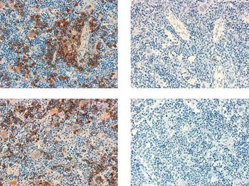 Image: Mouse spleens that were infiltrated by TAL-1-positive T-ALL leukemia cells taken from human patients, with leukemia cells shown in brown. Images on the right are from mice treated with GSK-J4, while the mice on the left were not treated with the compound (Photo courtesy of Dr. Aissa Benyoucef, Ottawa Hospital Research Institute).