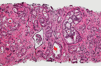 Image: Histopathology photomicrograph showing prostatic acinar adenocarcinoma (the most common form of prostate cancer) Gleason pattern 4, from prostate currettings (Photo courtesy of Nephron).
