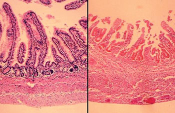 Image: Histopathology comparing normal bowel at the left, to a bowel involved by necrotizing enterocolitis (NEC) at the right showing hemorrhagic necrosis, beginning in the mucosa and extending to involve the muscular wall, with the potential for perforation (Photo courtesy of the University of Utah School of Medicine).