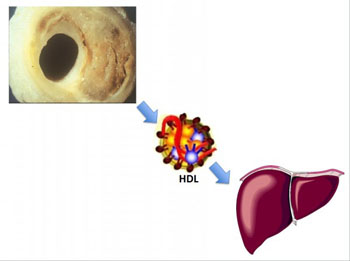 Image: HDL can remove cholesterol from arteries and shuttle it to the liver where it is eliminated, but this process can be disrupted in certain circumstances (such as deficiency of SCARB1) (Photo courtesy of Dr. Daniel Rader, University of Pennsylvania).
