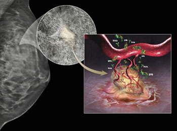 Image: The Videssa Breast diagnostic test provides accurate early detection and typing of breast cancers by combining anatomical evidence from imaging with evidence from its proteomics test for proteins released into the blood system by cancer tumors (Image courtesy of Provista Diagnostics).