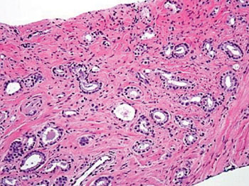 Image: Histopathology of prostate cancer showing medium-sized cribriform gland with somewhat irregular luminal spaces (on left) that would be assigned Gleason pattern 4 (Photo courtesy of European Urology).