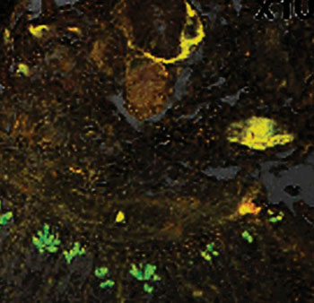 Image: Luminescent conjugated oligothiophene, h-FTAA staining of tissue showing amyloid deposits, yellow red fluorescence (Photo courtesy of Linköping University).