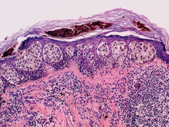 Image: Histopathology of a skin section from a patient with superficial spreading malignant melanoma (Photo courtesy of Profs. Leszek Wozniak and Krzysztof W. Zielinski).