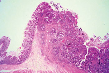 Image: Histopathology of colon adenocarcinoma composed of chaotic glandular structures that are lined by one or more rows of cancer cells with or without mucus production (Photo courtesy of the Johns Hopkins University).