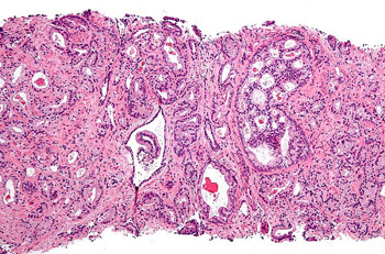 Image: Micrograph of a needle biopsy specimen of prostate adenocarcinoma, acinar type, the most common type of prostate cancer (Photo courtesy of Wikimedia Commons).