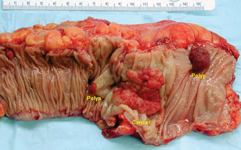 Image: Gross appearance of an opened colectomy specimen containing two adenomatous polyps and one invasive colorectal carcinoma (Photo courtesy of Emmanuelm).