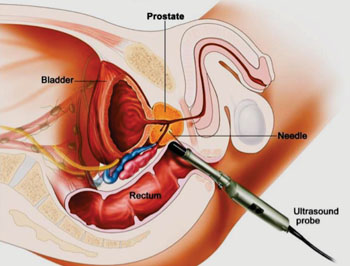 Image: Schematic diagram of a transrectal prostate biopsy (Photo courtesy National Cancer Institute).