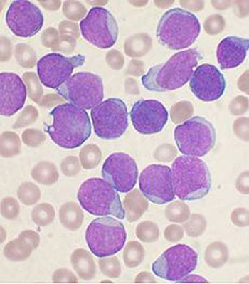 Image: A bone marrow aspirate smear showing precursor B-cell acute lymphoblastic leukemia cells. Chromosomal translocations and gene fusions are common in various types of leukemia (Photo courtesy of Wikimedia Commons).