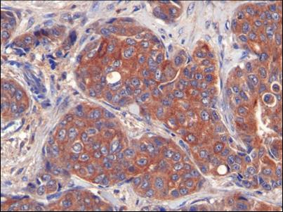 Image: A photomicrograph showing that breast tumor cells have high levels of LIPG (endothelial lipase) expression in their membranes (Photo courtesy of the Institute for Research in Biomedicine, Barcelona).