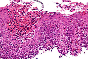 Image: A micrograph of eosinophilic esophagitis (EoE), H&E stain. Characteristic features are present: Abundant eosinophils—criteria vary; one common definition is: > 20 eosinophils/0.24 mm2; Papillae are elongated; papillae reach into the top 1/3 of the epithelial layer; Basal cell hyperplasia; > 3 cells thick or >15% of epithelial thickness; Spongiosis (Photo courtesy of Wikimedia).