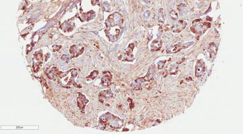 Image: High expression of COMP in breast cancer cells, seen here in brown, was associated with poor clinical prognosis for the patient. Cancer cells expressing COMP became more invasive and changed their metabolism, which allowed them to survive better and spread to other organs (Photo courtesy of Dr. Anna Blom, Lund University).