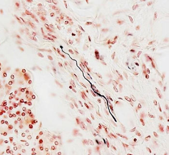 Image: Immunostaining: the black fiber is positive for alpha-synuclein pathology inside a nerve fiber in the submandibular gland (Photo courtesy of Journal of Parkinson\'s Disease).