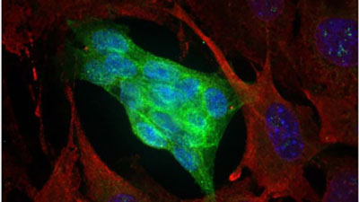 Image: An expression of NOTCH 1 (green color) in ACC stem cells (Photo courtesy of Yale University).