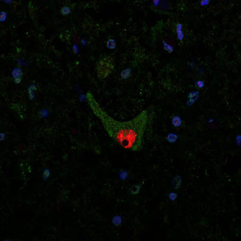 Image: Aggregated SOD1 protein can be seen as green dots in the cell fluid of a motor neuron in the spinal cord of an ALS patient. The red area is the nerve cell nucleus (Photo courtesy of Peter Andersen, Umeå University).