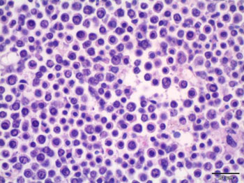 Image: A photomicrograph showing multiple myeloma cells in the bone marrow (Photo courtesy of the University of Miami School of Medicine).