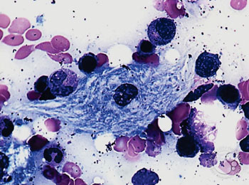 Image: A bone marrow aspirate biopsy of a patient with Gaucher Disease; the cytoplasm has wrinkled tissue paper appearance (Photo courtesy of the American Society of Hematology).