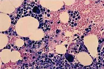 Image: A photomicrograph of a bone marrow aspiration biopsy showing drug-induced agranulocytosis (Photo courtesy of NMH).