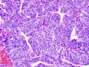 Image: A histologic view of an endometrial adenocarcinoma showing many abnormal nuclei (Photo courtesy of Wikimedia Commons).