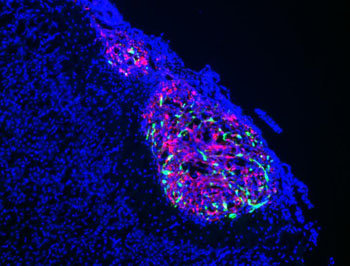 Image: A fluorescent micrograph of glioblastoma cells (Photo courtesy of the International School of Advanced Studies).