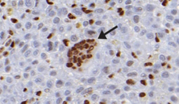 Image: In some cancers, including chondroblastoma and a rare form of childhood sarcoma, a mutation in histone H3 reduces global levels of methylation (dark areas) in tumor cells but not in normal cells (arrowhead). This mutation arrests the cells in a proliferative state to promote tumor development (Photo courtesy of The Rockefeller University).