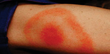 Image: The typical erythema migrans or bulls-eye rash often but not always seen in Lyme disease (Photo courtesy of the CDC).