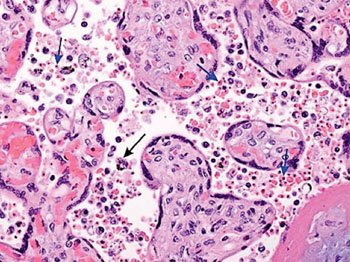 Image: A photomicrograph of placental tissue revealing the presence of the malarial parasites. The blue arrows point to examples of red blood cells containing pigment and the black arrow points to an example of a pigment-containing histiocyte (Photo courtesy of Drucilla J Roberts, MD).