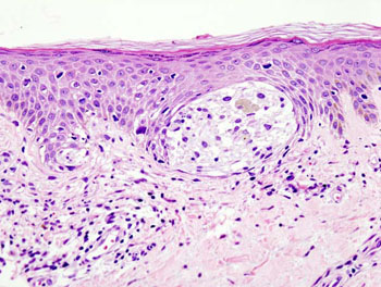 Image: A skin biopsy with melanoma present (Photo courtesy of Wikimedia Commons).