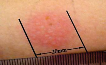 Сильноположительная реакция на  туберкулиновую кожную пробу  Манту (фото любезно предоставлено Mudnsky).