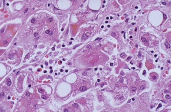 Image: A histopathology of Hepatitis C viral infection of the liver, necrosis and inflammation are prominent, and there is some steatosis (Photo courtesy of the University of Utah Medical School).