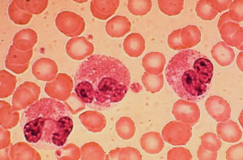 Image: A peripheral blood film showing three eosinophils from a patient with eosinophilia (Photo courtesy of the University of Maryland).