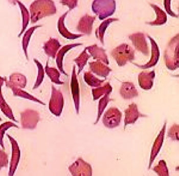 Image: A photomicrograph of sickle-shape red blood cells from a patient with sickle cell disease (Photo courtesy of the CDC).