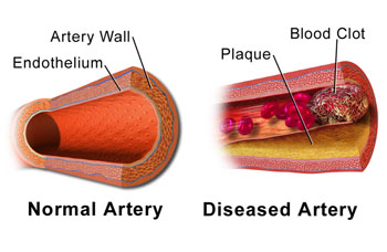 Image: An illustration comparing normal artery versus diseased artery with a blood clot (Photo courtesy of Wikimedia Commons).