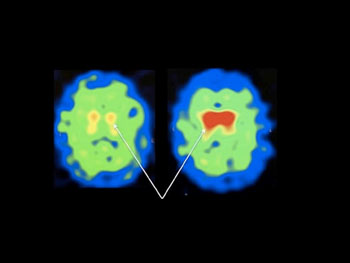 Image: Brain scans from a patient showing dopamine transporter binding (red) before and after a three-month NAC treatment (Photo courtesy of Thomas Jefferson University).