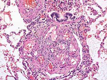 Image: Lung tissue with lesions caused by pulmonary hypertension (Photo courtesy of Bulent Celasun, MD / Wikimedia).