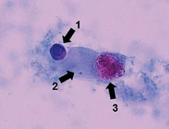 Image: A photomicrograph of (#1) a round cell in urine sediment Sternheimer stain; (#2) a hyaline cast; (#3) and a macrophage (Photo courtesy of the University of Tokyo).