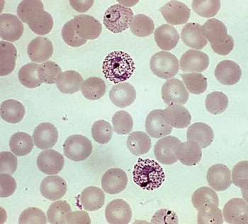 Image: A photomicrograph of a blood smear containing both immature and mature trophozoites of the Plasmodium vivax parasite (Photo courtesy of Dr. Mae Melvin / CDC).