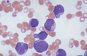 Image: A photomicrograph of a blood smear from a patient with acute myeloid leukemia, with very large, immature myeloblasts with many nucleoli (Photo courtesy of the CDC).